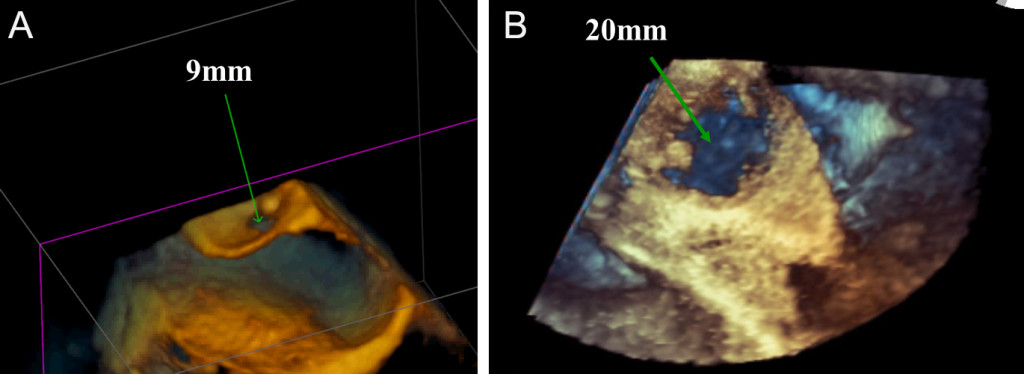 Fig. 1. A. 3DTEE imaging of the heart shows the CTS membrane that separated the left atrium into two chambers with a 9 mm hole that allowed restricted blood flow. B. 3DTEE shows the CTS membrane after balloon dilation with a diameter of 20 mm. 