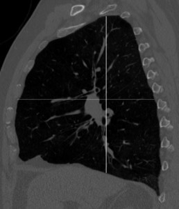 Fig. 1. Hyperinflated lungs consistent with COPD