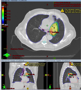 A Three-Dimensional Conformal Radiation Therapy planning in a left sided lung tumor. High dose distribution cover the disease, sparing the surrounding heath tissue.