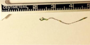 Fig. 2. Photograph of partially expelled Essure device (inner PET rod) passed vaginally during menses.