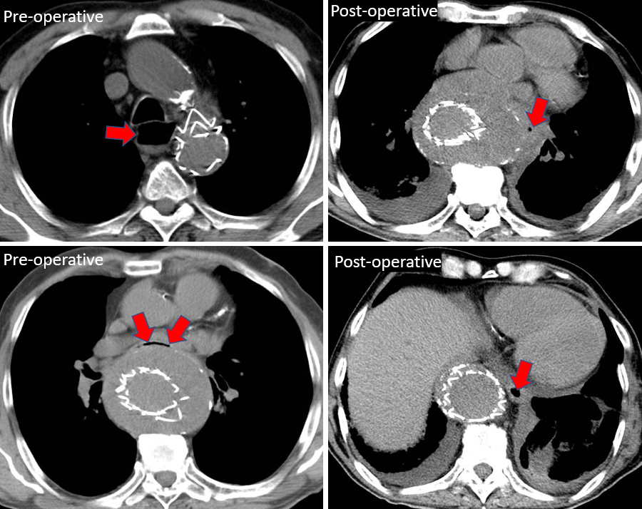 pre-operative chest computed tomography axial image showing esophageal dilation above the level