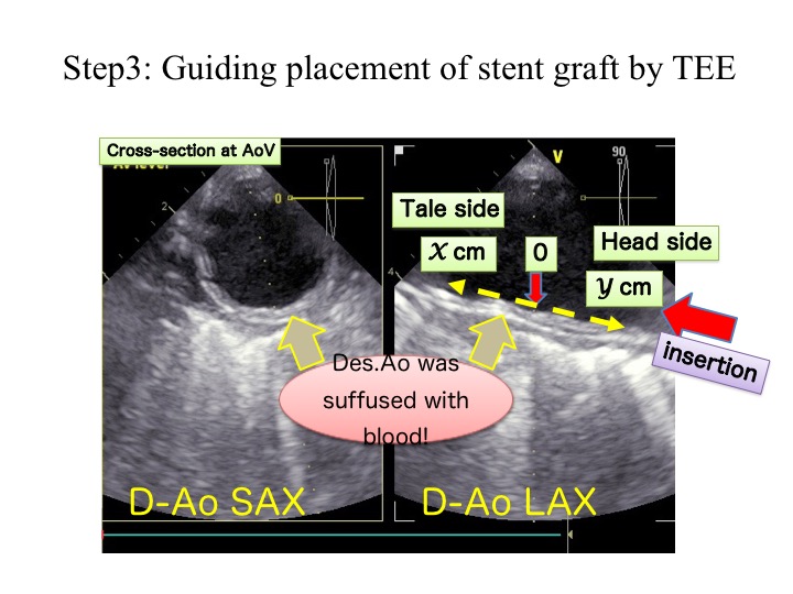 Guiding placement of stent graft by TEE 