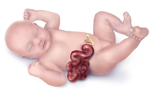 Inside Out: Treating Patients with Gastroschisis. Atlas of Science
